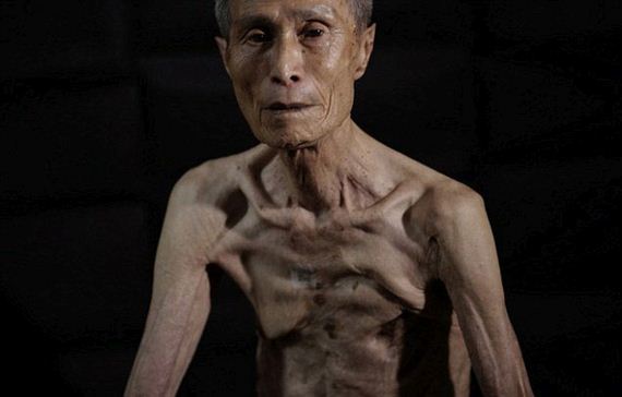 scars_nuclear_war