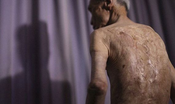 scars_nuclear_war