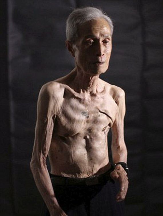 scars_nuclear_war