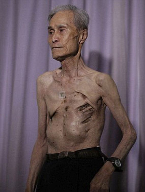 scars_nuclear_war