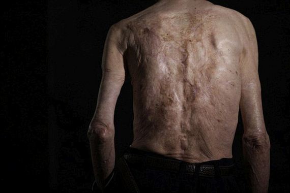 scars_nuclear_war